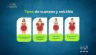Fabián Idrovo, cirujano plástico, explica por qué aparece la celulitis en hombres y mujeres y qué alternativas existen para prevenirla y tratarla de forma adecuada.