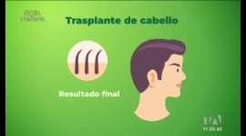 El especialista Juan Esteban Arízaga nos explica qué es la alopecia, una enfermedad que afecta la confianza de hombre y mujeres. Además, de tratamientos efectivos.