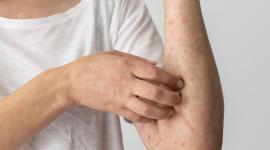 Alerta epidemiológica por casos de sarampión en Perú