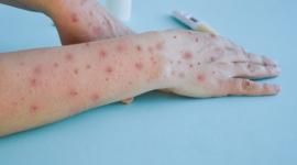 La nueva variante de la viruela del mono registra su primer caso en Ecuador.