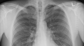 Qué tiene más radiación: un vuelo comercial o una radiografía médica?