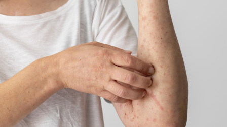 Alerta epidemiológica por casos de sarampión en Perú