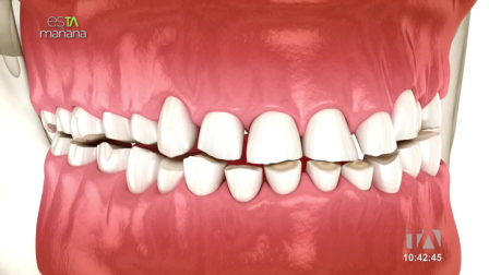 Sofía Carrión , terapeuta, nos explica como aparece el bruxismo que afecta al 22% de la población mundial.