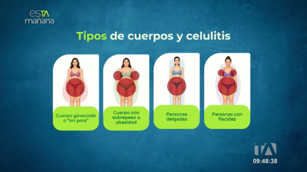 Fabián Idrovo, cirujano plástico, explica por qué aparece la celulitis en hombres y mujeres y qué alternativas existen para prevenirla y tratarla de forma adecuada.
