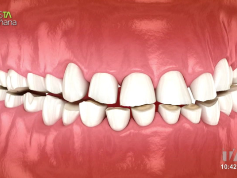 Sofía Carrión , terapeuta, nos explica como aparece el bruxismo que afecta al 22% de la población mundial.